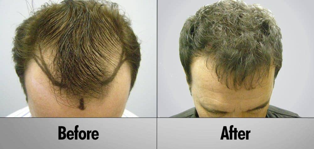 Patient 15 Before and After top view - Wavy hair European male