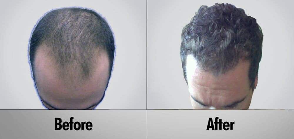 Patient 14 Before and After Hair Transplant