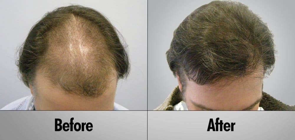 Patient 8 Before and after hair transplant