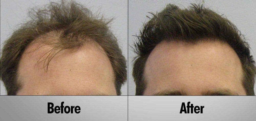 Hair Transplant Patient 7 Before and after