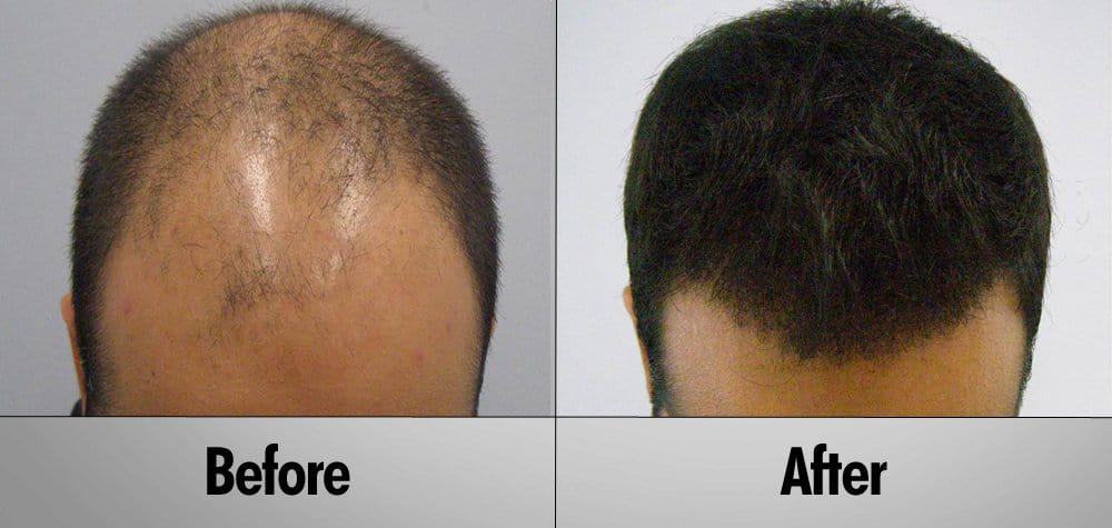 Patient 8 South Asian male before and after hair transplant