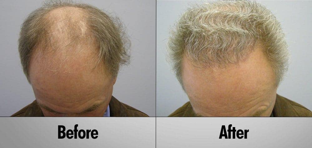 Grey Hair transplant make before and after patient 7
