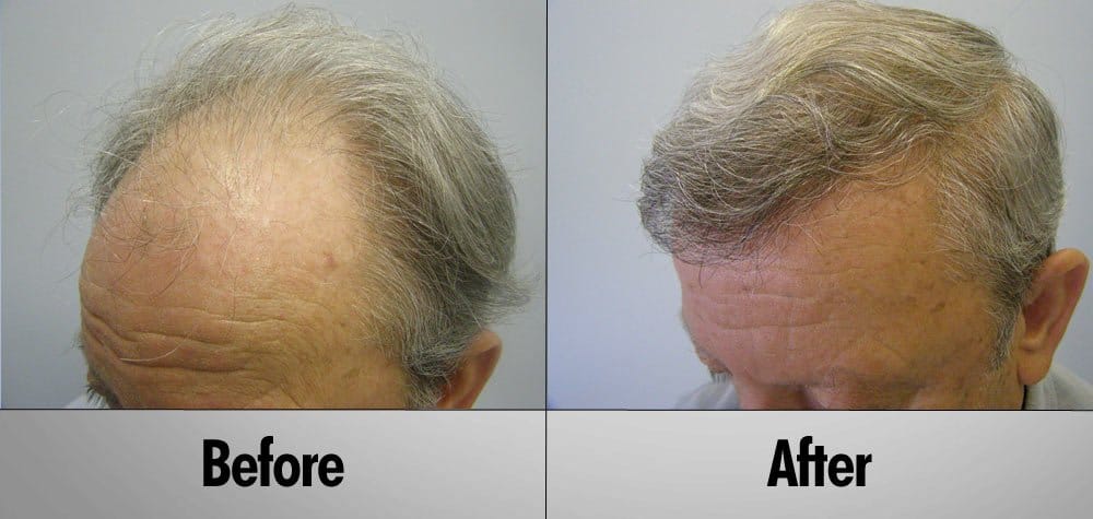 Senior grey hair male before and after hair transplant