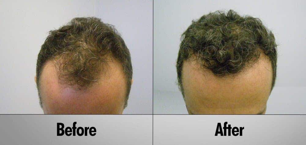 Wavy Hair male before and after hair transplant