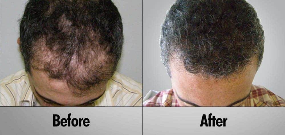 Patient 9 Before and after hair transplant