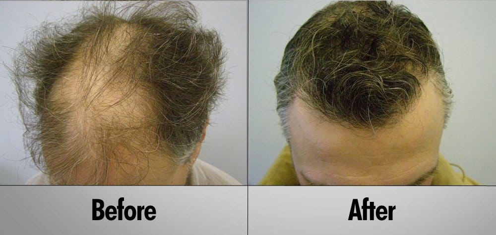 Hair Transplant Patient 16 before and after top front view