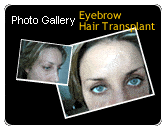 Eyebrow Hair Transplant Photo Gallery