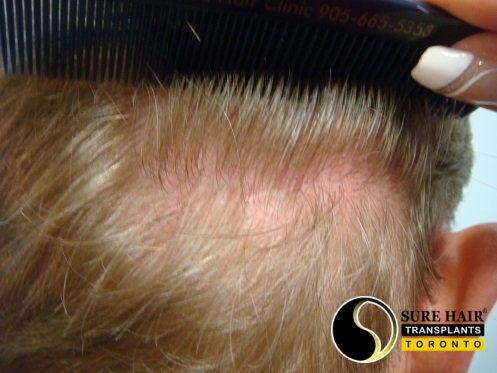 FUT donor area after - right side