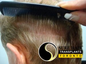 FUT donor area after - left side