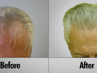 Senior blonde male before and after hair transplant