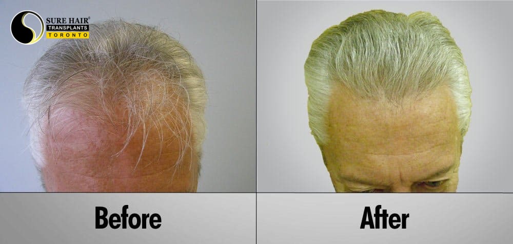 Senior Citizen Hair Transplant