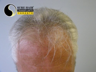 Senior blonde male front view before hair transplant