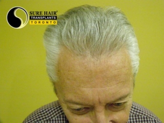 Senior blonde male front view after hair transplant