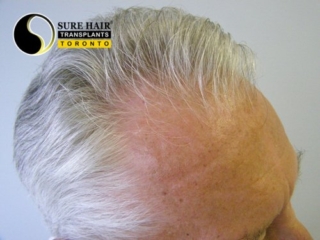 Senior blonde male top right side before hair transplant