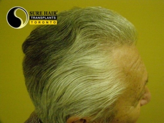 Senior blonde male top right side after hair transplant