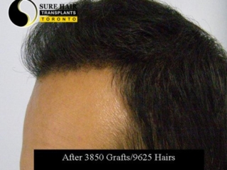 Patient 8 South Asian male left side after hair transplant