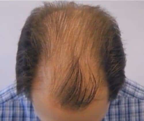 Top view of head Norwood 7 hair loss pattern before FUT hair transplant