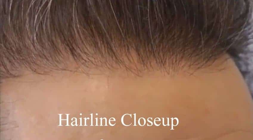After Hair Transplant Hairline Close-up