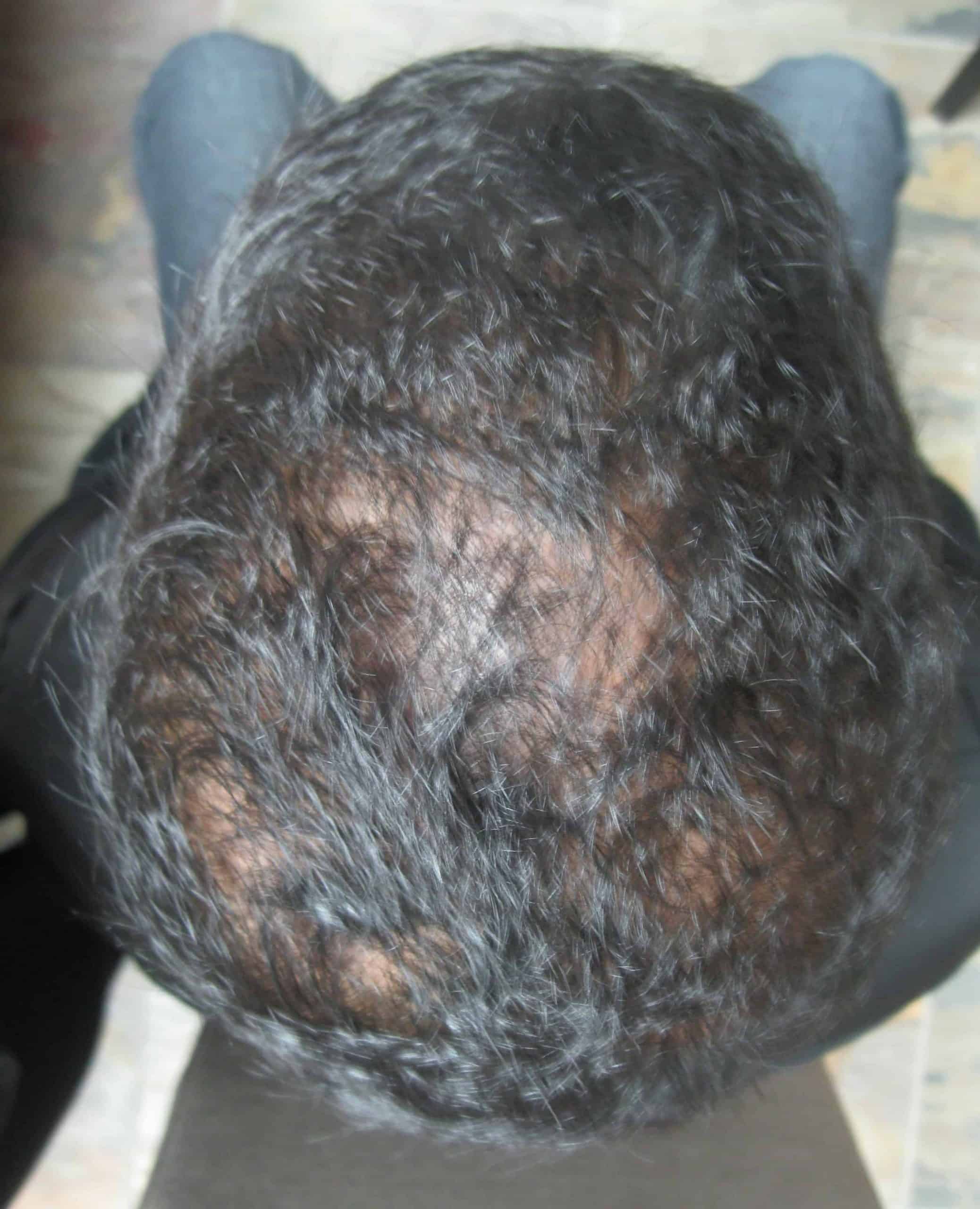 Paul after 6 Months of  laser hair therapy Treatment