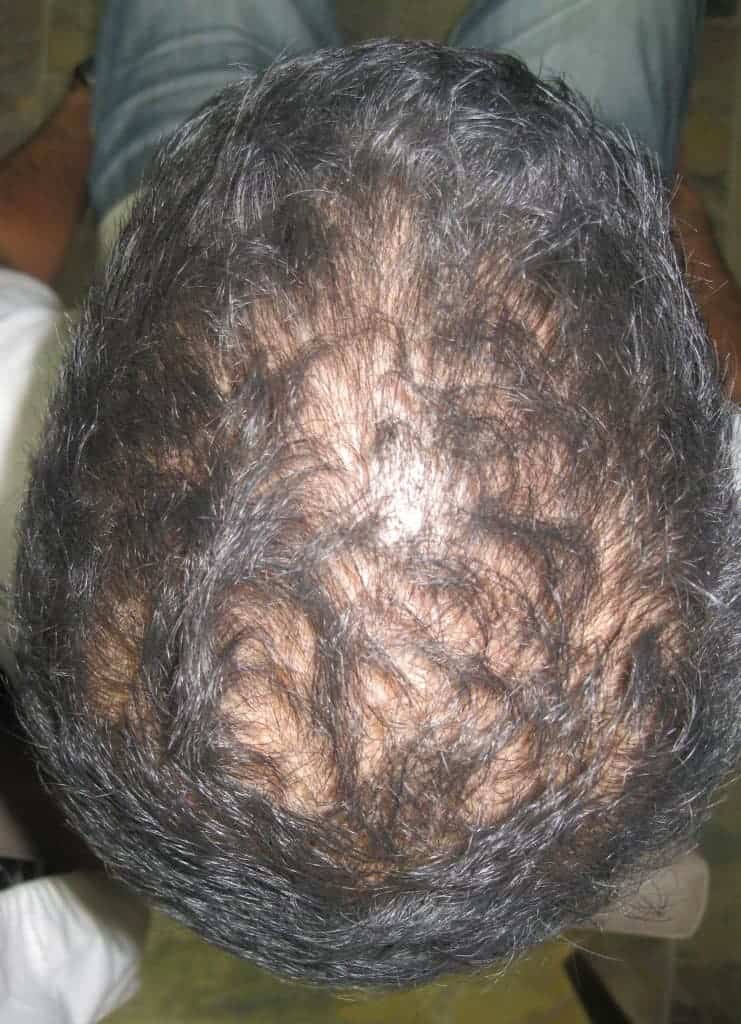 Paul before 6 Months of  laser hair therapy Treatment