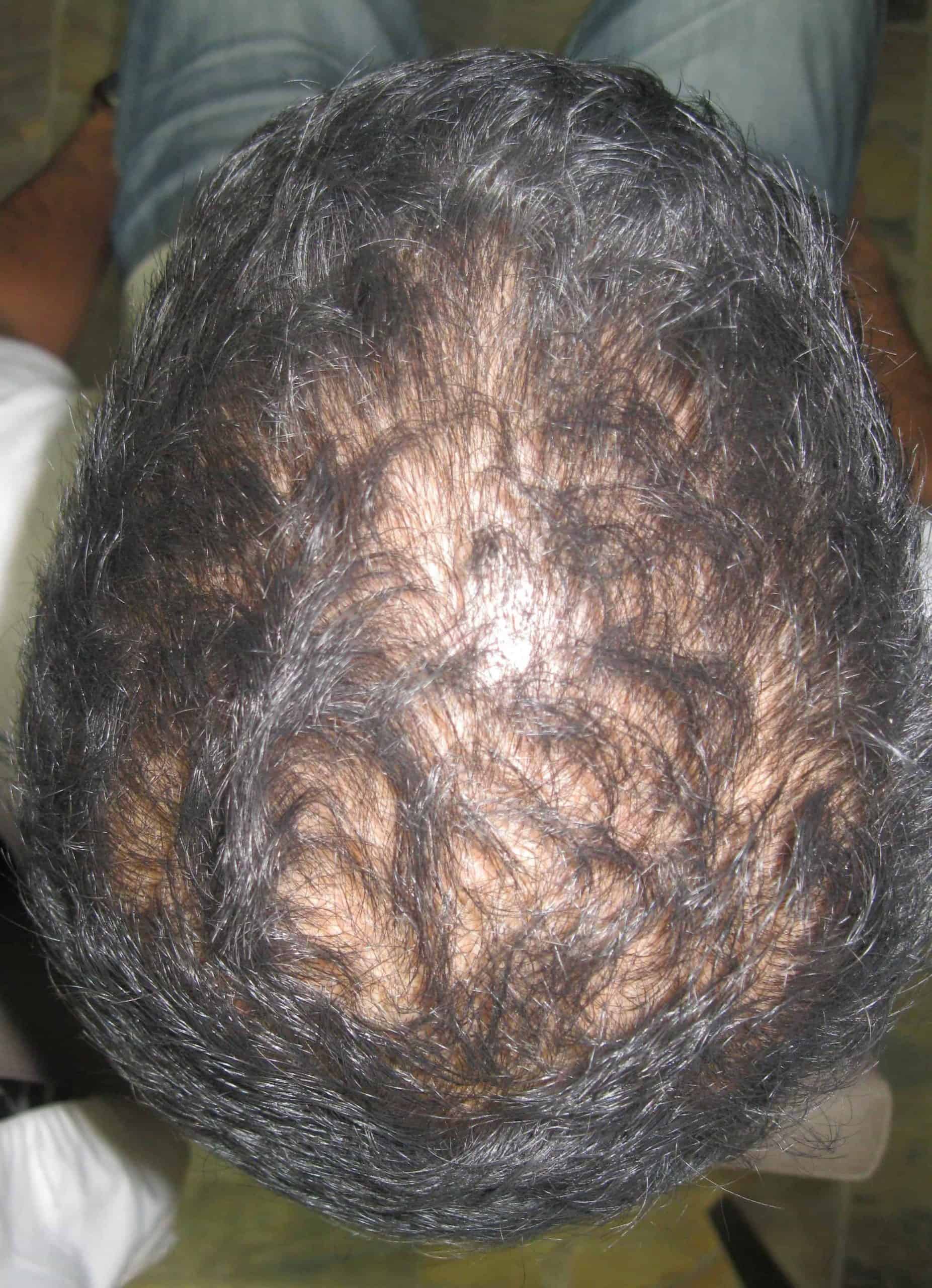 Paul before 6 Months of  laser hair therapy Treatment