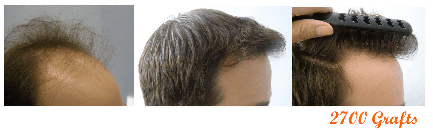Why Should You Choose Surehair for your hair transplant?