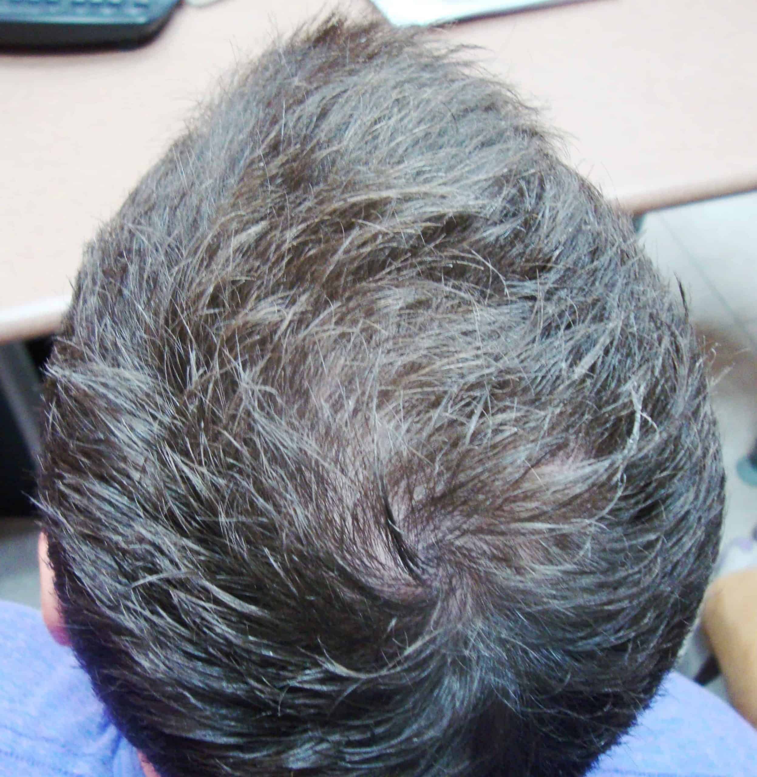 Ryan 3 Months of laser hair therapy Treatment
