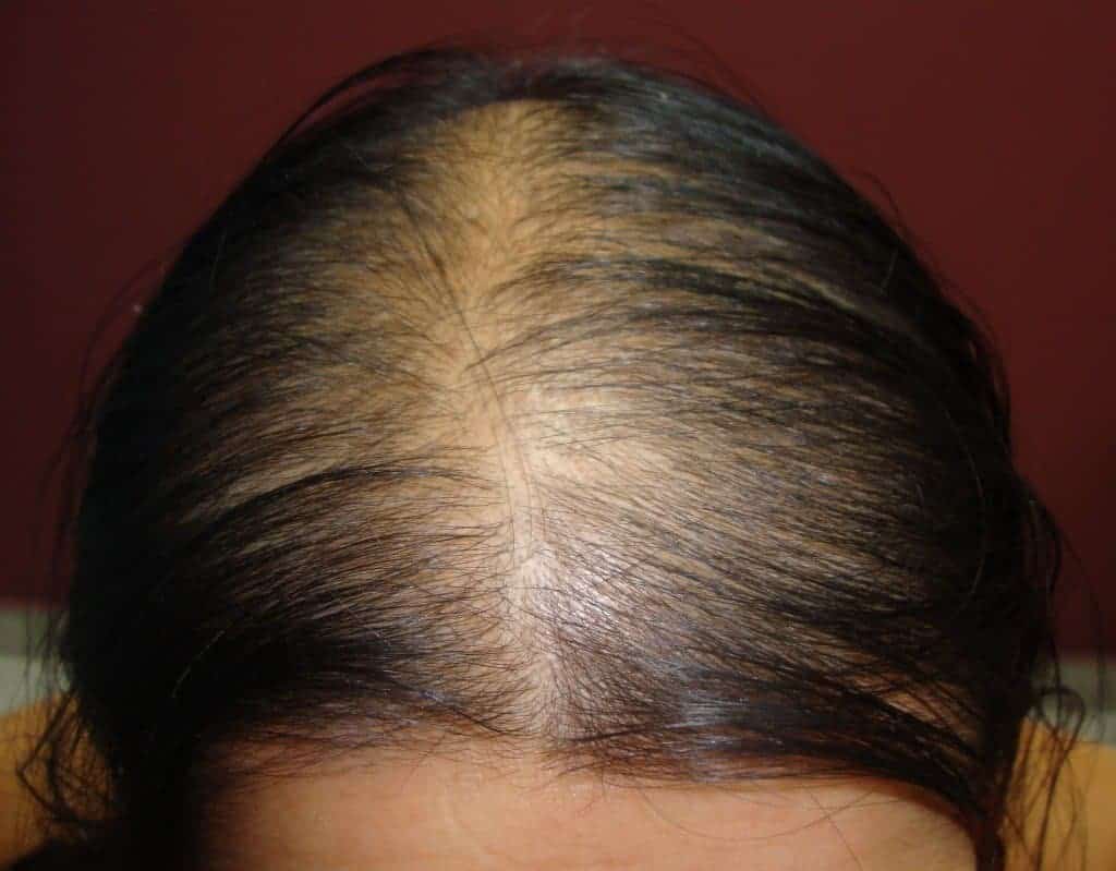 PRP Hair Regrowth Treatment Before Client 4 Hairline