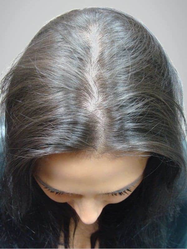 Top laser hair treatment & regrowth program client 3 gallery