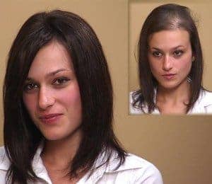 female-hair-restoration 2