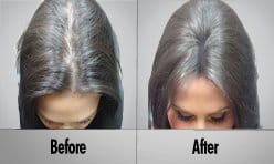 Laser Hair Treatment & Regrowth program Female Client Gallery