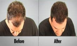 Male Hair Thickening & Regrowth Treatment