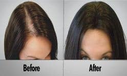 Female Non-Surgical Hair Loss Solutions
