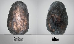 Laser Hair Treatment & Regrowth program Client 1 Gallery