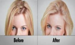 Female Hair Thickening & Regrowth Treatment