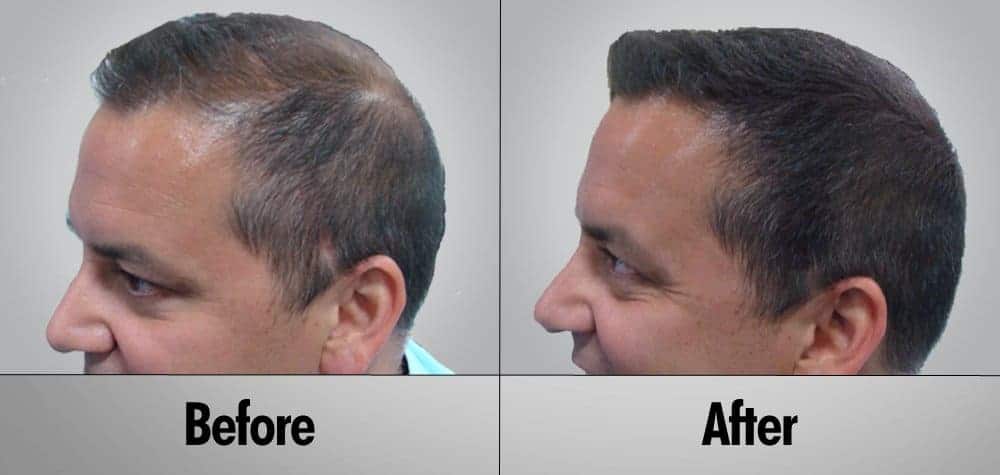 The Most Advanced Hair Restoration Solutions Now Available