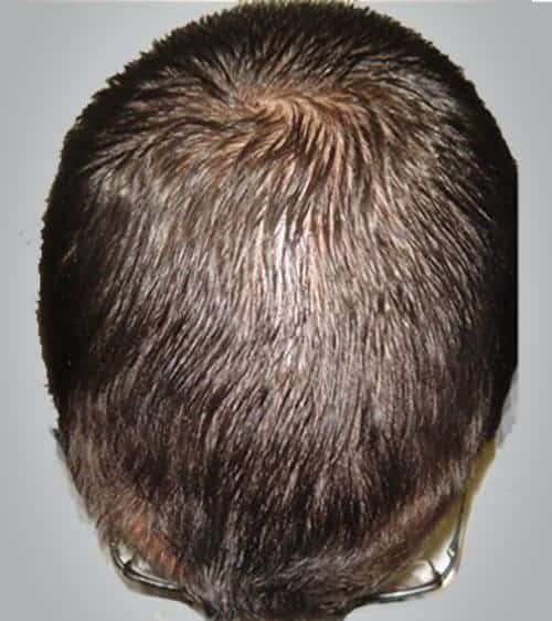 laser hair treatment & regrowth client 248 Gallery