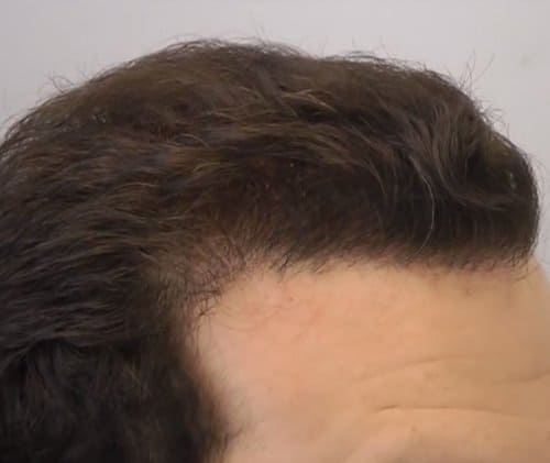 Right Side After Hair Transplant