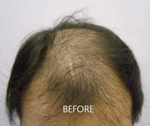 Asian male patient before Hair Transplant frontal view