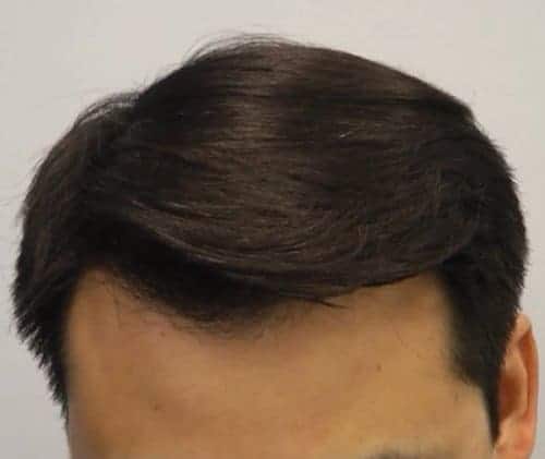 Asian male patient after Hair Transplant frontal view
