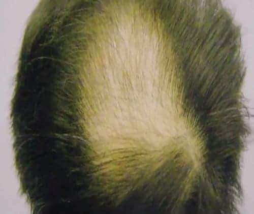 Asian male patient Crown Before Hair Transplant