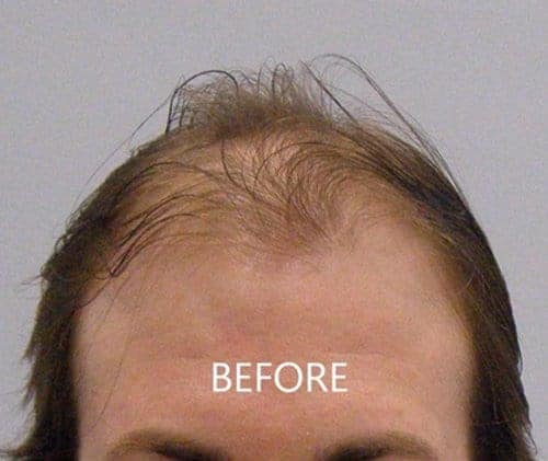 Before Hair Transplant Front