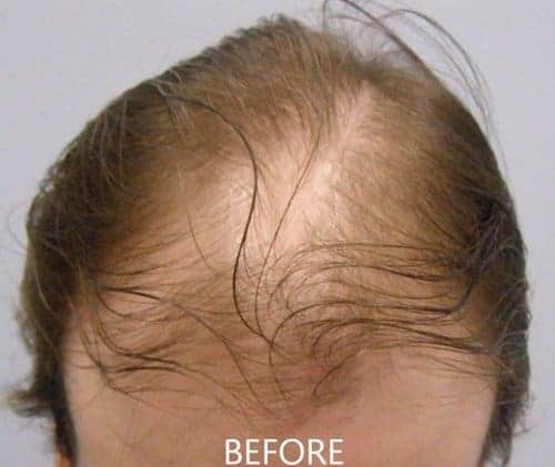 Before Hair Transplant Top