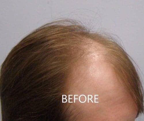 Before Hair Transplant Right