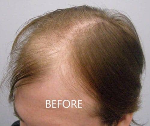 Before Hair Transplant Left