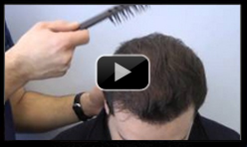 3300 Graft Hair Transplant video