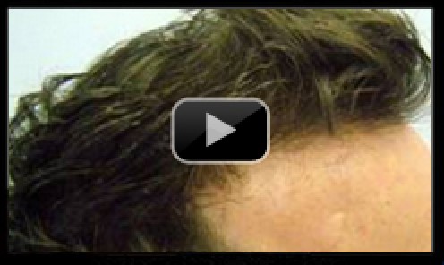 High Density Hair Transplant Before & After
