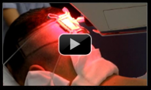 Artas Robotic Hair Transplant Video