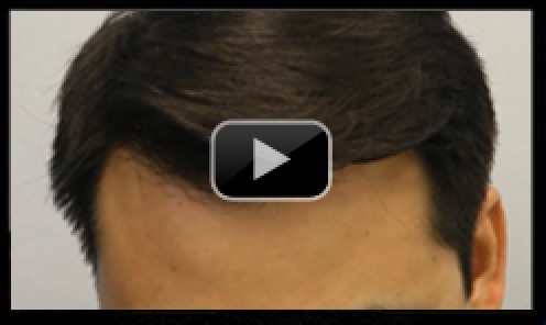 Asian Male Hair Transplant Video