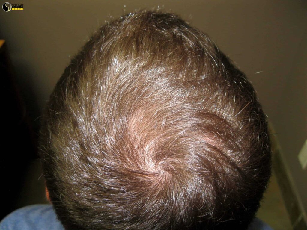 Ryan Before laser hair therapy